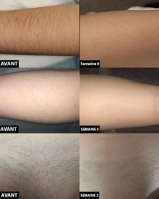 Hair Removal Device Light-Based Rechargeable Full Body Use