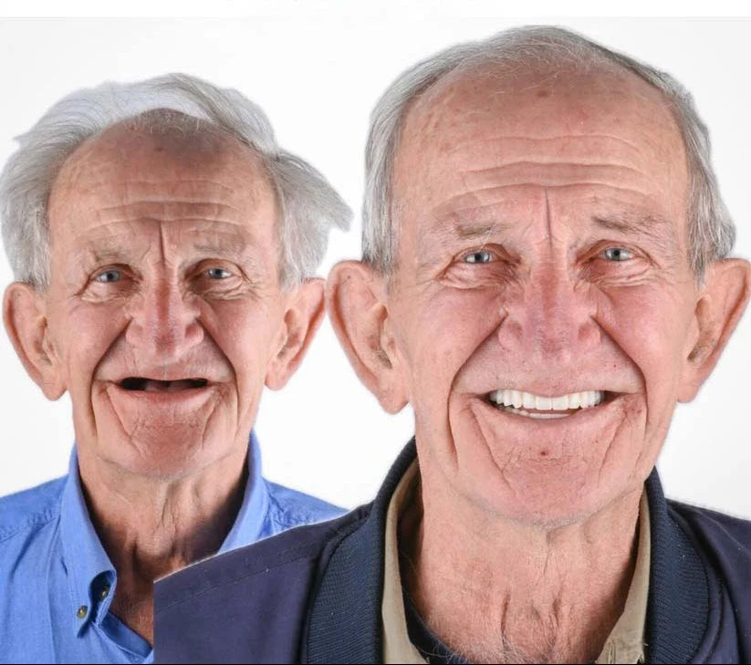 Cosmetic Denture Set Moldable Upper & Lower At-Home Fit