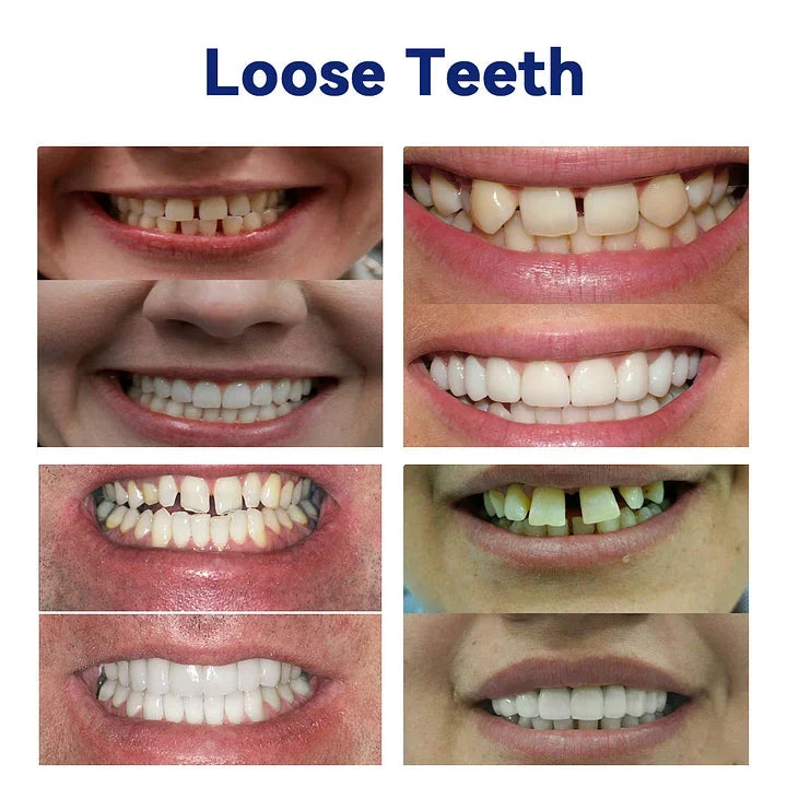 Dentures Flexible Upper & Lower Set Waterproof