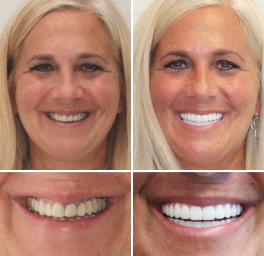 Dentures Moldable Custom-Fit Upper & Lower Set