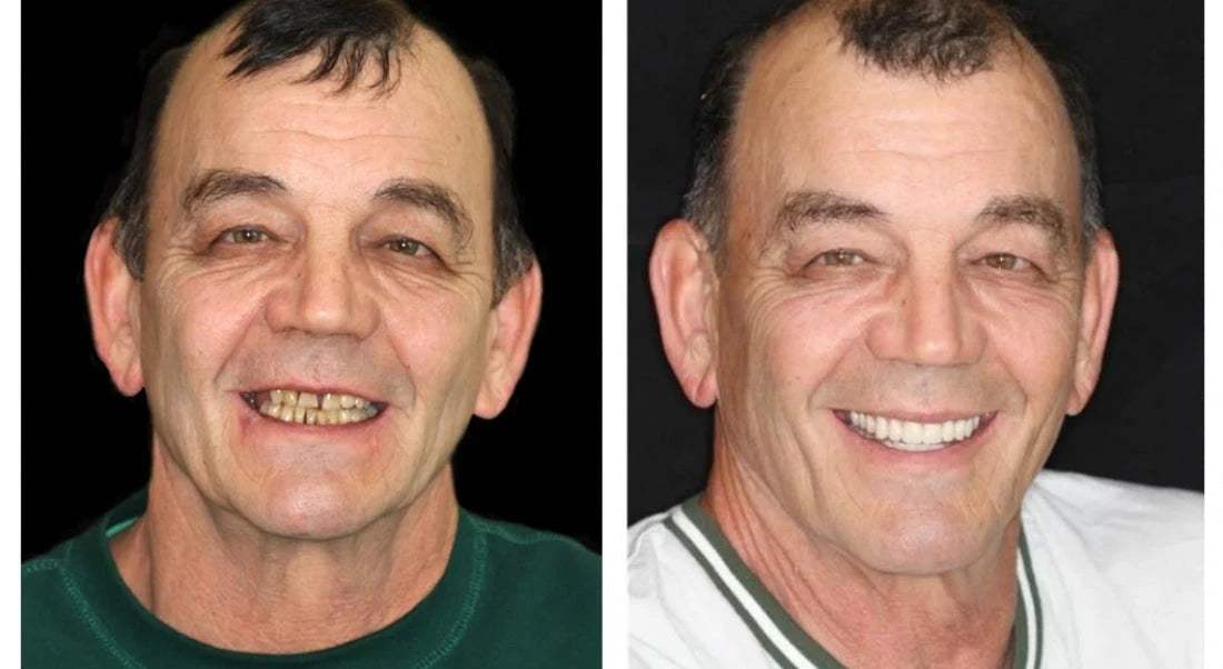 Dentures Moldable Custom-Fit Upper & Lower Set
