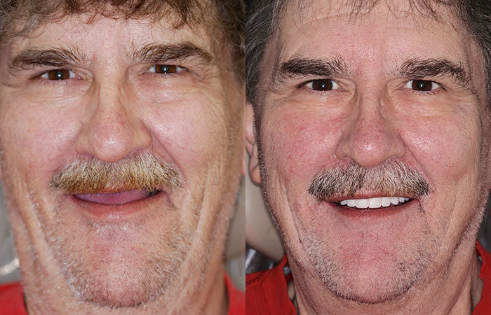Dentures Moldable Custom-Fit Upper & Lower Set