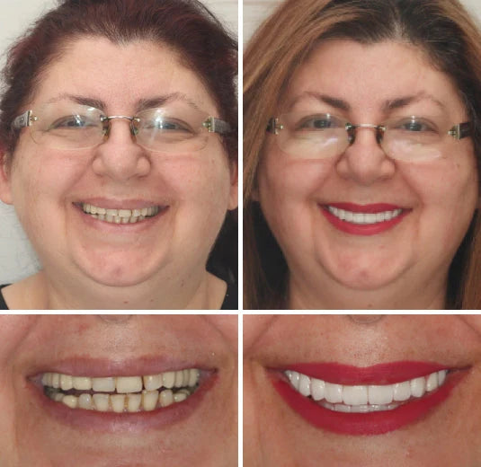 Dentures Moldable Custom-Fit Upper & Lower Set