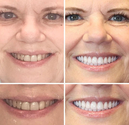 Dentures Moldable Custom-Fit Upper & Lower Set