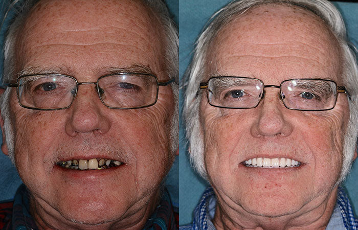 Dentures Moldable Custom-Fit Upper & Lower Set
