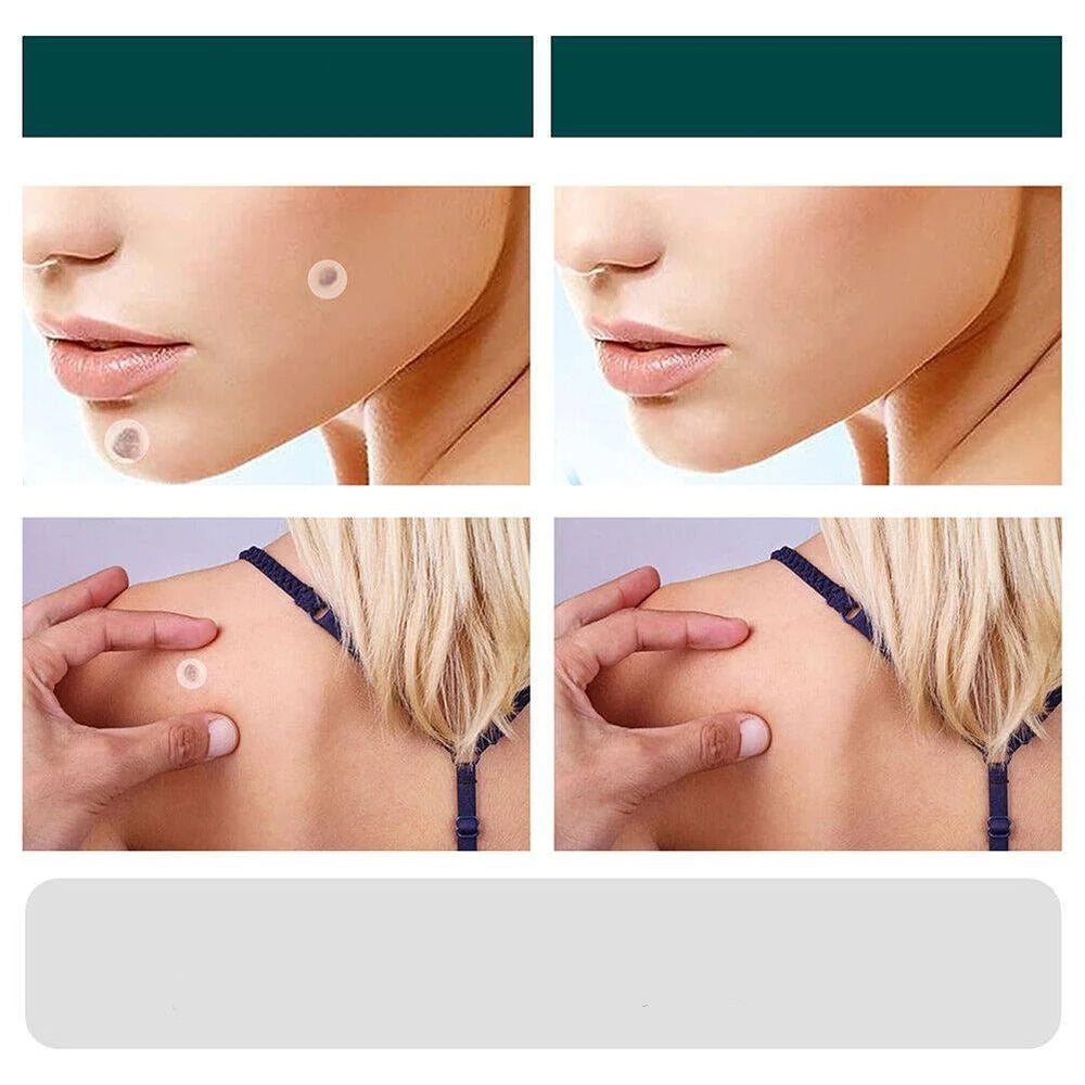 Wart & Skin Tag Patches Transparent Hydrocolloid 120 Count
